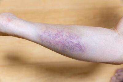 男性下腿、打ち身、打撲、挫傷、肉離れ、内出血