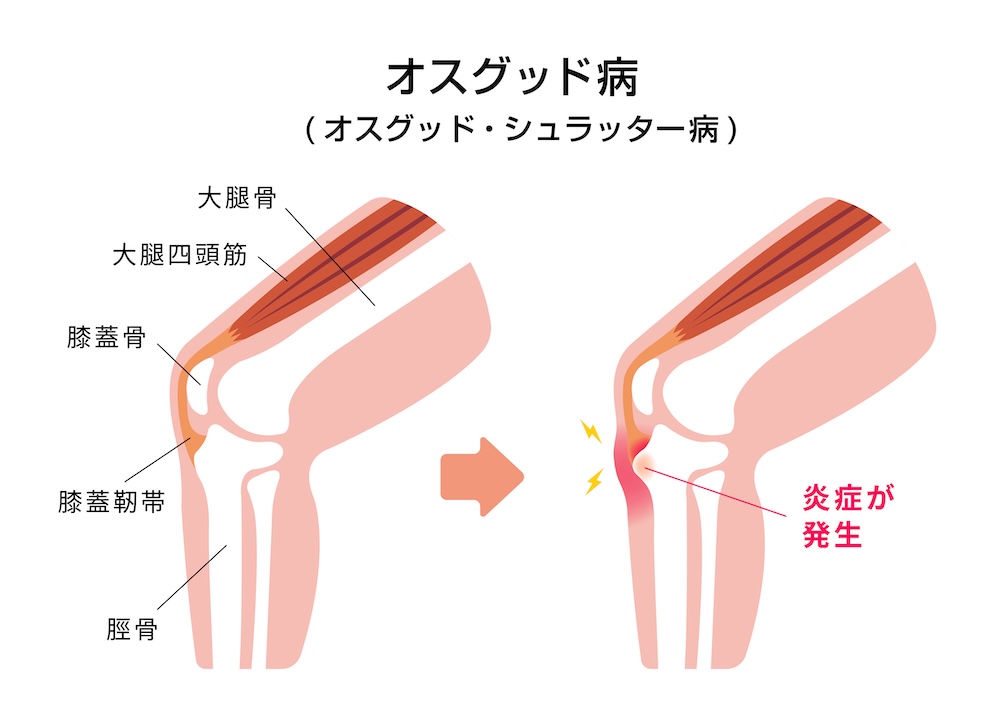オスグッド病図