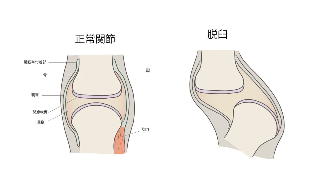 脱臼