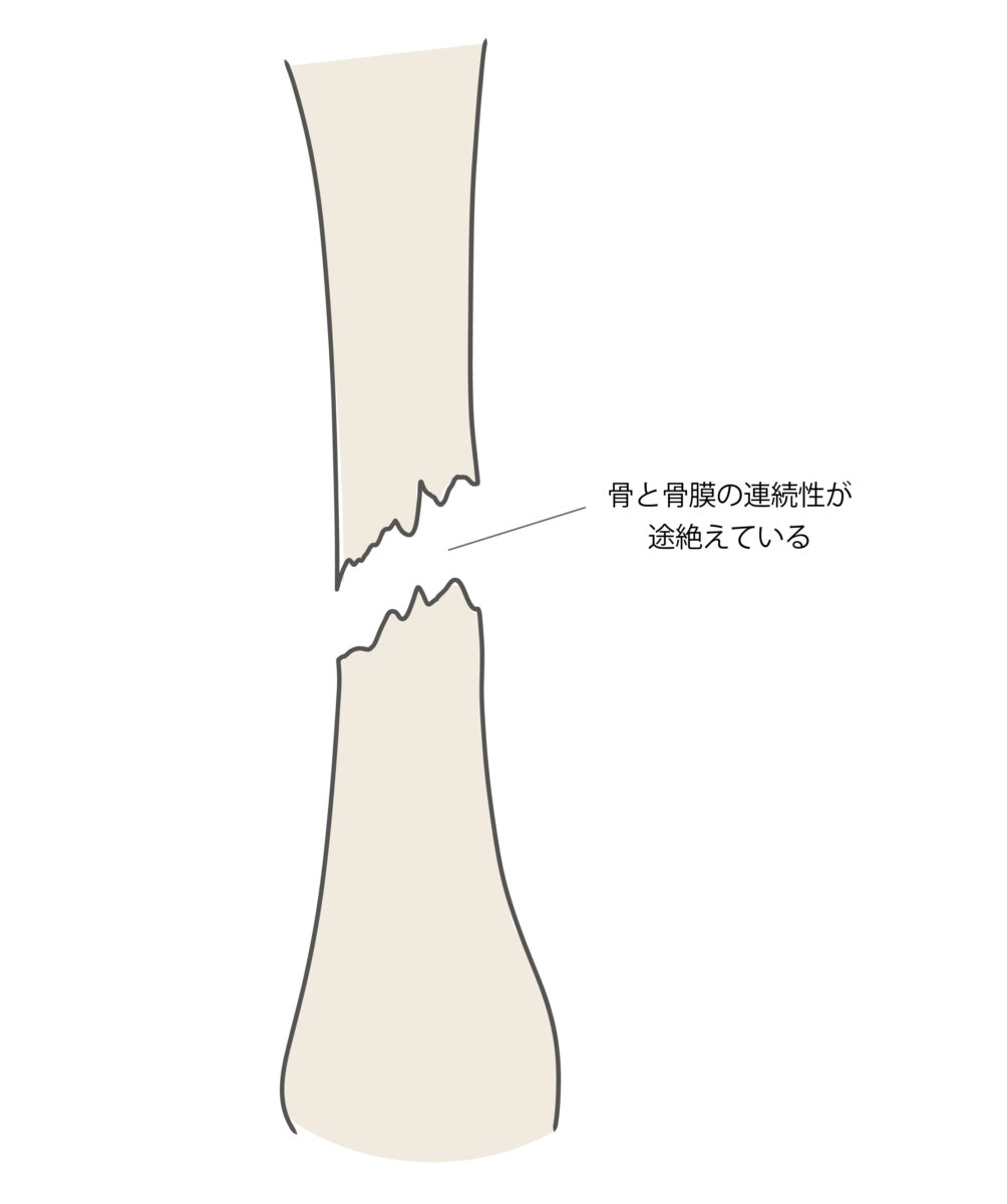 【骨折・脱臼でお困りの方へ】多い部位と応急処置・リハビリ─夙川の丸山接骨院のサポート
