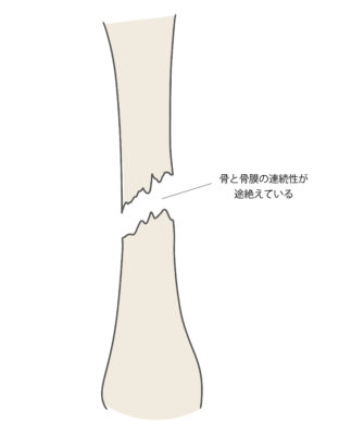 【骨折・脱臼でお困りの方へ】多い部位と応急処置・リハビリ─夙川の丸山接骨院のサポート